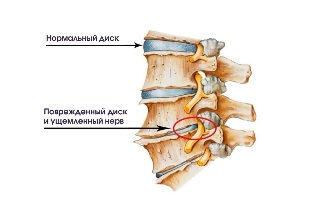 Симптомдору моюн остеохондроза